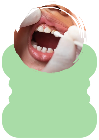 fluoride application